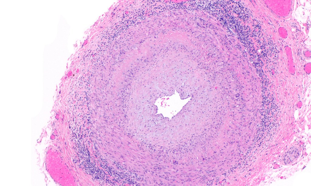 Kopfschmerzen im Alter = Riesenzellarteriitis!