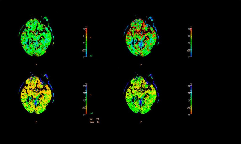 CT-Perfusion: Über- oder&nbsp;unterschätzt?