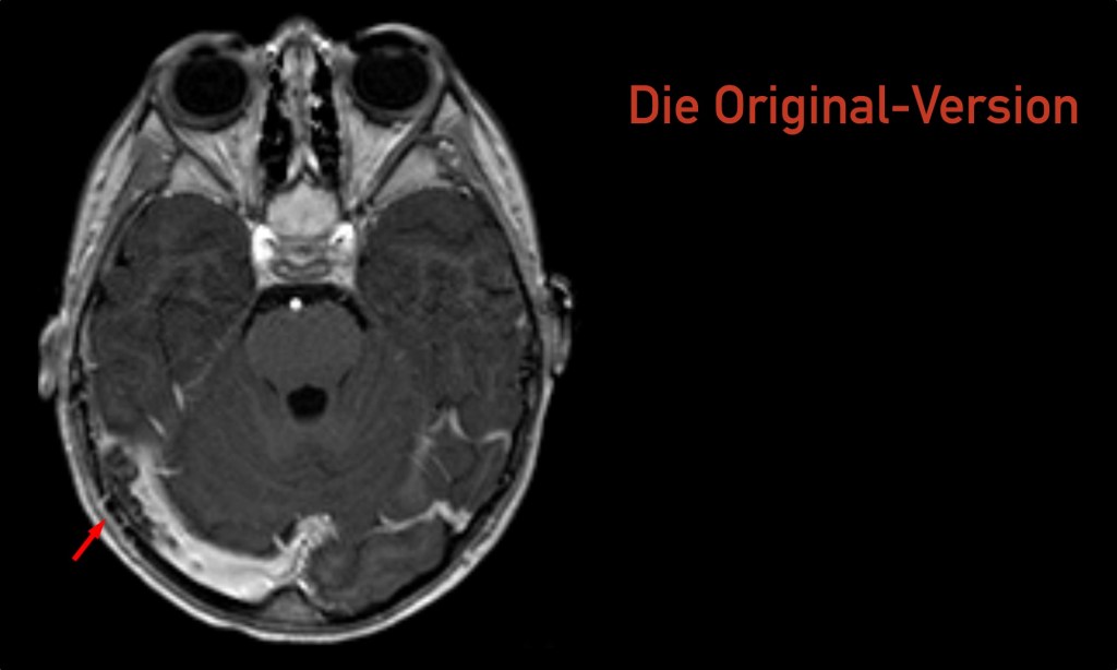 Die Originalversion: Zerebrale Sinus- und Hirnvenenthrombosen nach AstraZeneca-Impfung