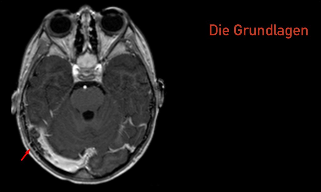 Zerebrale Sinus- und Hirnvenenthrombosen nach AstraZeneca-Impfung: Die&nbsp;Grundlagen