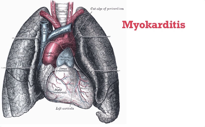 Ein Twitter-Drama in drei Akten: Myokarditis ohne Corona, mit Corona und nach&nbsp;COVID-Impfung
