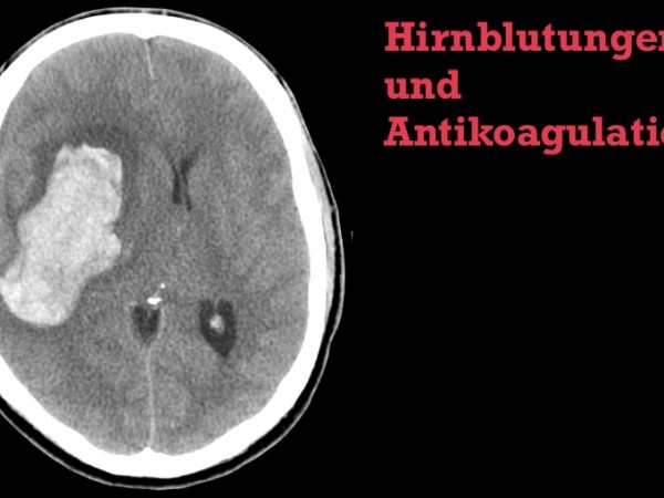 Intrazerebrale Blutungen und&nbsp;Antikoagulation