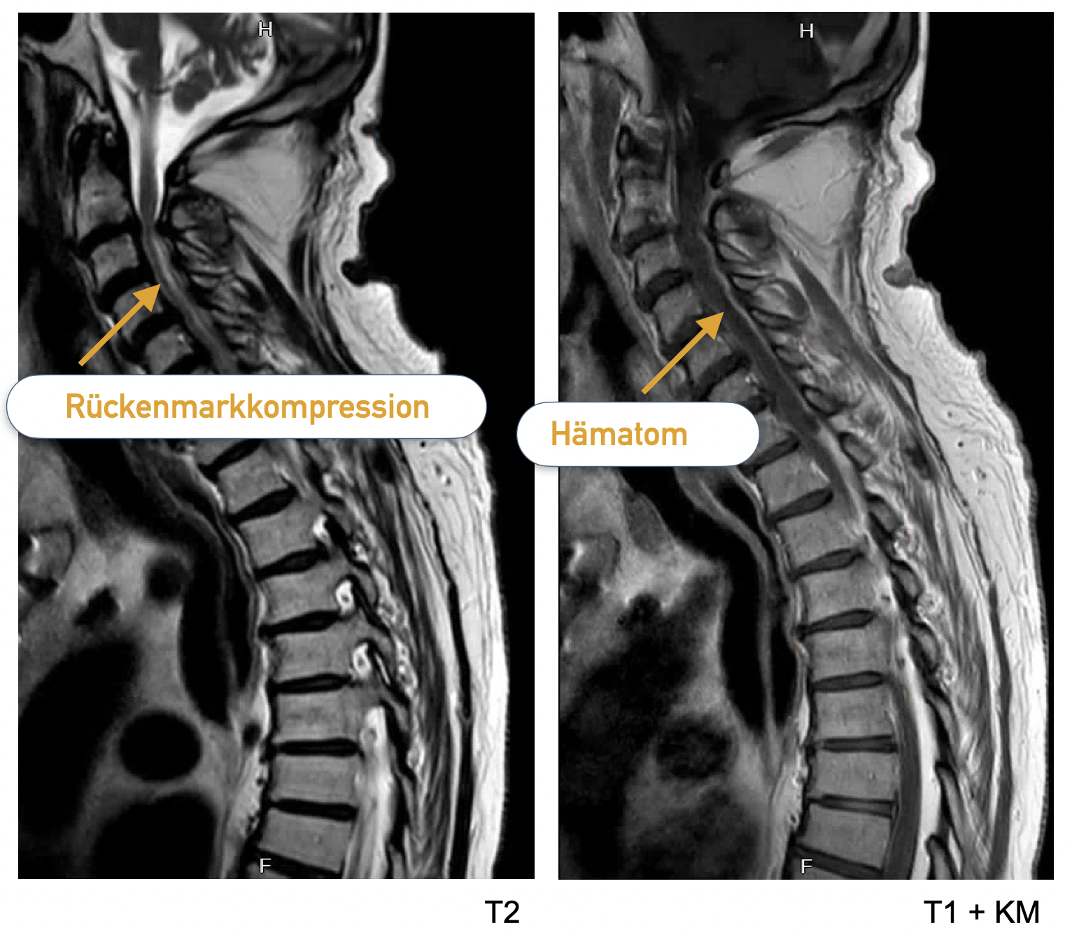 MRT der HWS, links sagittale T2-Wichtung, rechts sagittale T1-Sequenz mit KM