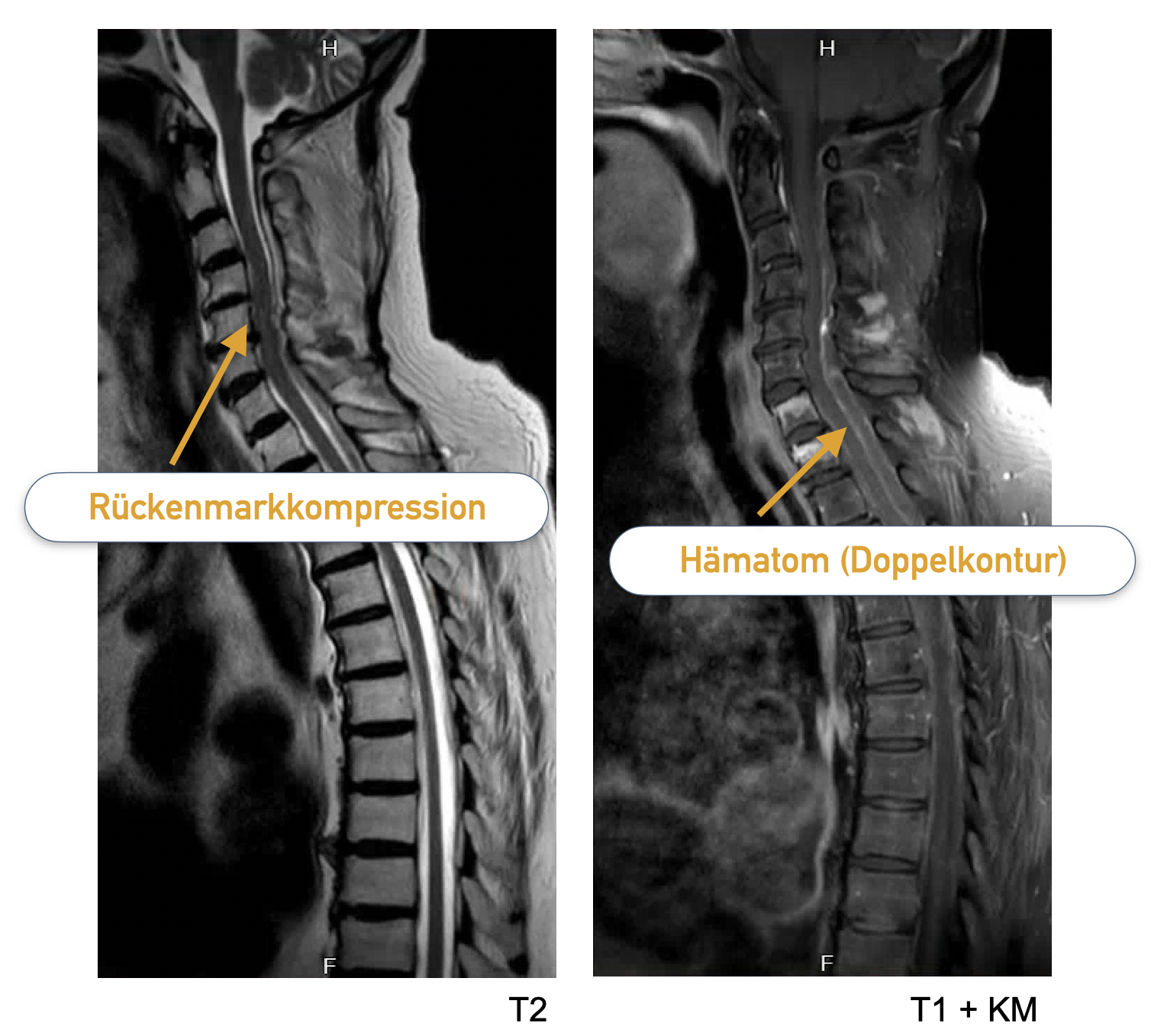 MRT der HWS, links sagittale T2-Wichtung, rechts sagittale T1-Sequzenz mit KM