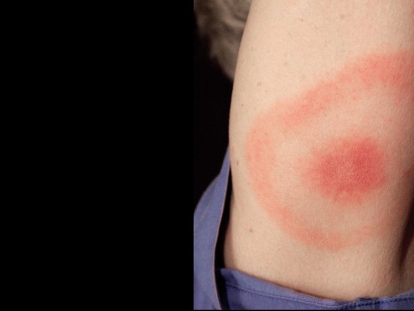 Neuroborreliose und Borrelienneurose