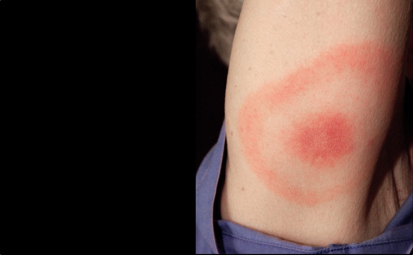 Neuroborreliose und Borrelienneurose