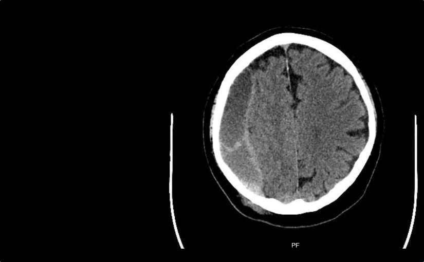 Das leichte und das nicht so leichte Schädel-Hirn-Trauma