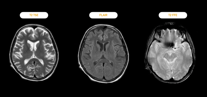 Neuroradiologie 101 MRT F r Neurologen Brainpainblog neuroradiologie-101-mrt-f-r-neurologen-brainpainblog