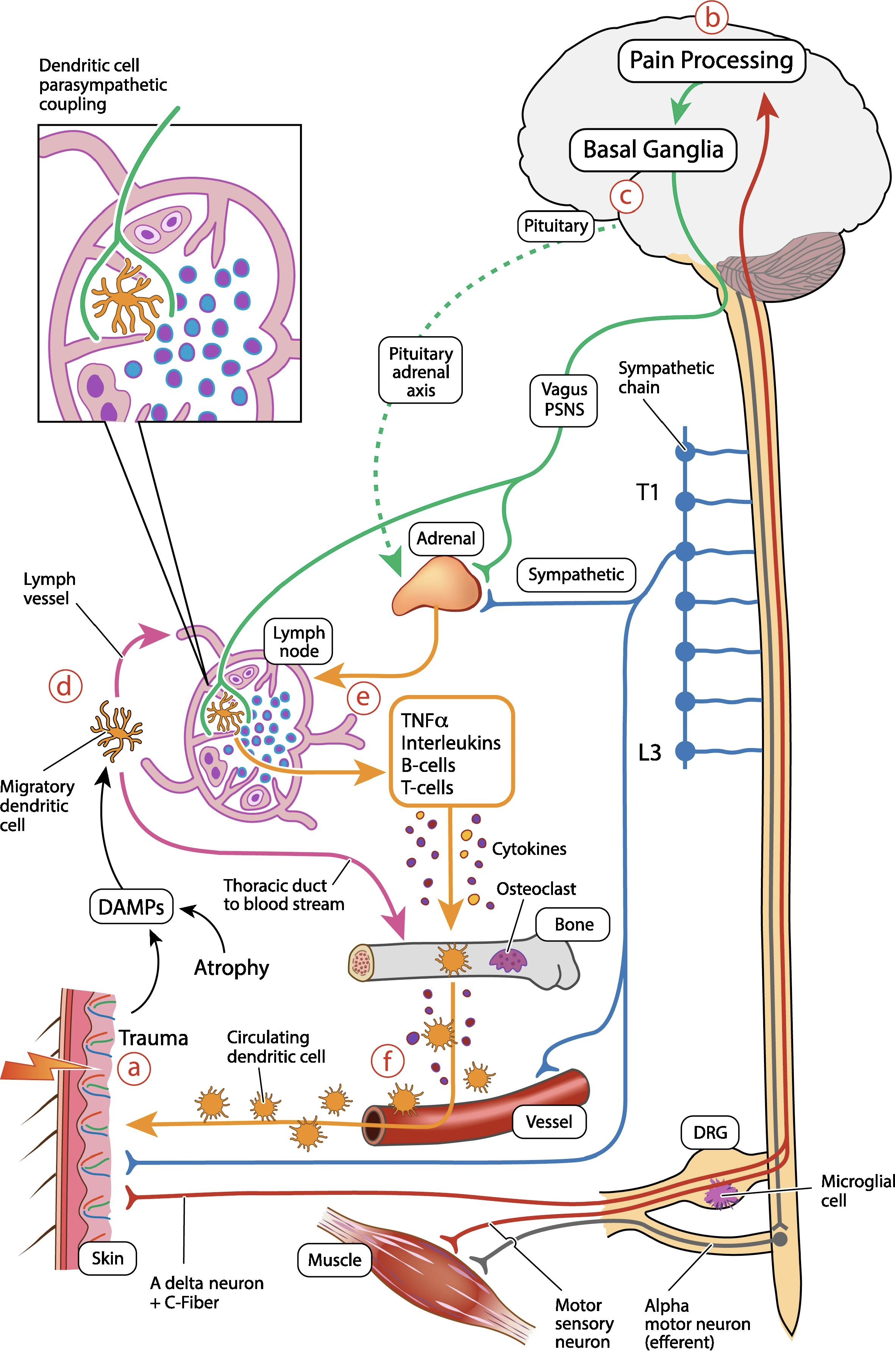 Pathogenese des CRPS, aus Russo et al.